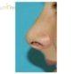 G. A. (Rhinoplasty Review)