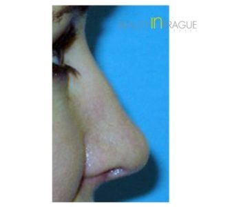 E. P. (Nose Tip Reshaping Review)