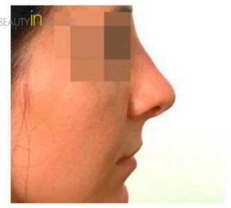 M. G. (Rhinoplasty Review)