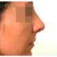 M. G. (Rhinoplasty Review)