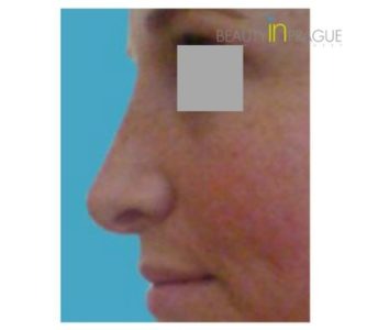 CH. (Rhinoplasty Review)