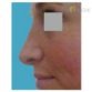 CH. (Rhinoplasty Review)