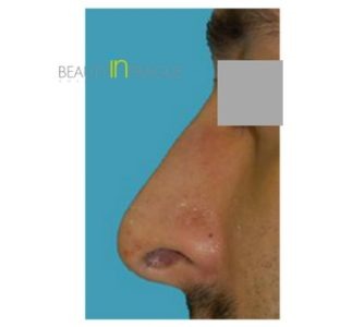 R. A. (Rhinoplasty Review)