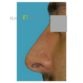 R. A. (Rhinoplasty Review)