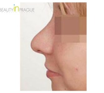 C. W. (Rhinoplasty Review)