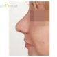 C. W. (Rhinoplasty Review)