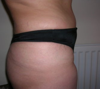 Denise, UK (Liposuction, Tummy Tuck Review)