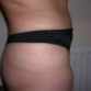 Denise, UK (Liposuction, Tummy Tuck Review)