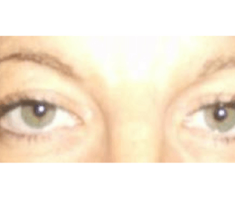 June, UK (Eyelid surgery Review)