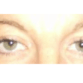 June, UK (Eyelid surgery Review)