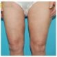 M. C. (Thigh Lift Review)