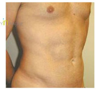 P. J. C. (Male Liposuction Review)