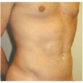 P. J. C. (Male Liposuction Review)