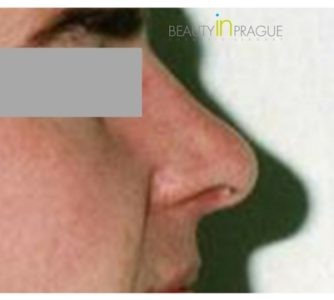 J. L. (Rhinoplasty Review)