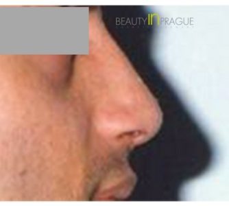 C. S. (Rhinoplasty Review)