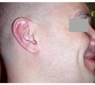 S. N. (Rhinoplasty Review)