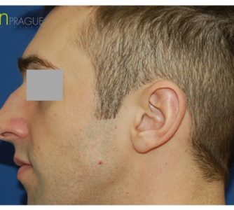 M. N. (Rhinoplasty Review)