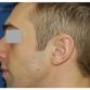 M. N. (Rhinoplasty Review)