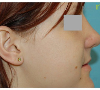 M. B. (Rhinoplasty Review)