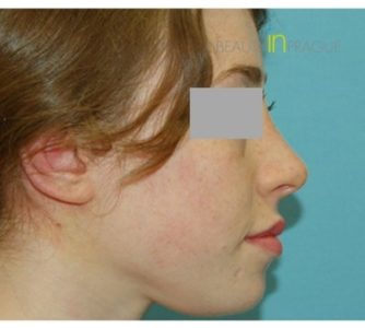 G. T. (Rhinoplasty Review)