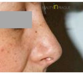 L. H. (Rhinoplasty Review)