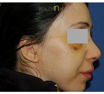 O. S. (Rhinoplasty Review)