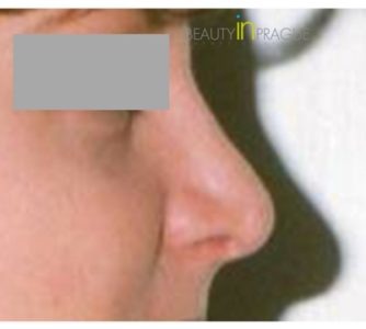 M. E. (Rhinoplasty Review)