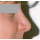 M. E. (Rhinoplasty Review)