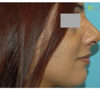 P. H. (Rhinoplasty Review)