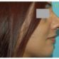 P. H. (Rhinoplasty Review)