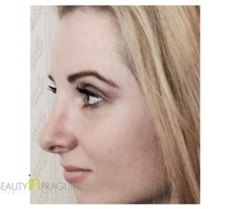 Ashley (Rhinoplasty, Breast Augmentation Review)