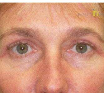 Anna (Eyelid surgery Review)