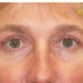 Anna (Eyelid surgery Review)