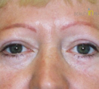 Eva (Eyelid surgery Review)