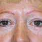 Eva (Eyelid surgery Review)