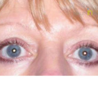 Ruth (Eyelid surgery Review)