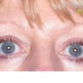Ruth (Eyelid surgery Review)