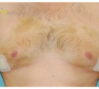 John, UK (Male Breast Reduction Review)
