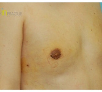 George, UK (Male Breast Reduction Review)