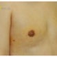 George, UK (Male Breast Reduction Review)