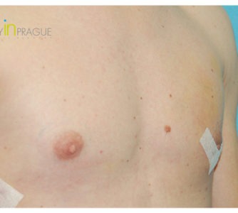 Andy, UK (Male Breast Reduction)
