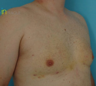 William, UK (Male Breast Reduction Review)