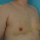 William, UK (Male Breast Reduction Review)