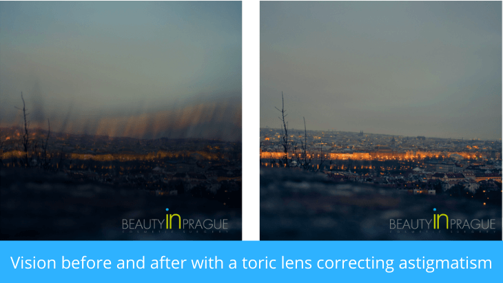 Cataract Removal & Lens Replacement surgery abroad - Prague